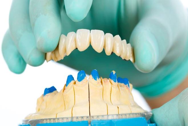 Dental Bridges