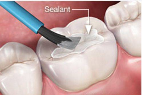 dental sealants permanent